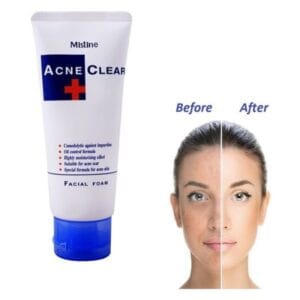 Acne Clear Facial Foam Wash – 85ml | Oil Control & Gentle Care for Acne-Prone Skin